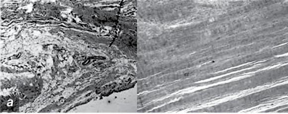 Figure 16.8 Pathologic changes in tendinopathy. Collagen organization: H&E. Increased proteoglycan.
