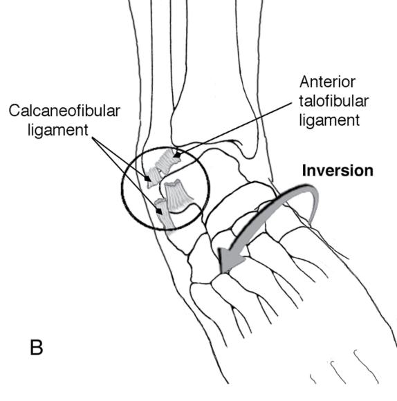 Figure 6.40 In plantar flexion (right foot), (A) the anterior talofibular ligament (ATFL) is almost vertical and can be readily sprained with (B) inversion.