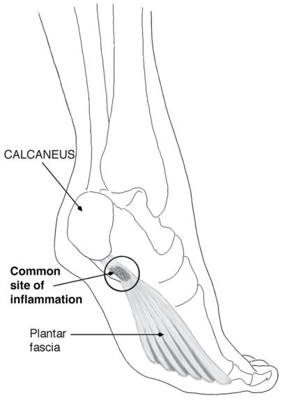 Figure 6.41 Common site of pain with plantar fasciitis (left foot, posteromedial view).