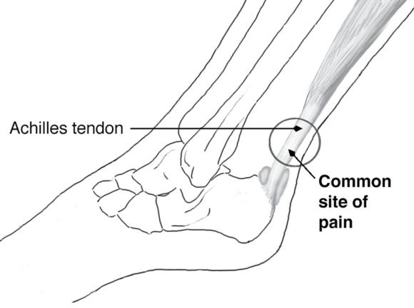 Figure 6.42 Common site of pain and thickening with Achilles tendinopathy (left foot, lateral view).