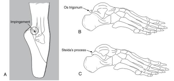 Figure 6.43 (A) Posterior ankle impingement risk increased by the presence of (B) an os trigonum or (C) a Stieda's process (right foot, lateral view).