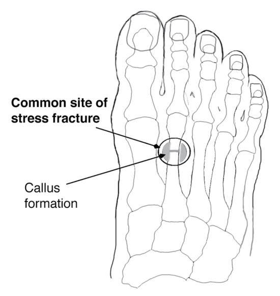 Figure 6.45 Common site of stress fracture in dancers (right foot, superior view).