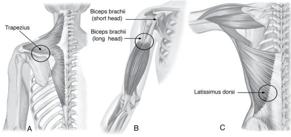 Figure 2.5 Attachments of muscles onto bones (A) directly, or indirectly through a (B) tendon or (C) aponeurosis.