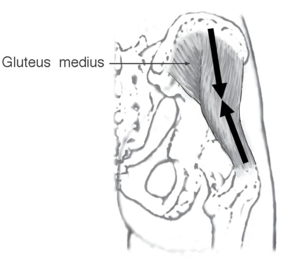 Figure 2.7 Approximate line of pull of the gluteus medius.