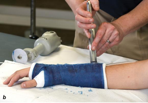 Figure 1.24 Hold the cast saw blade perpendicular to the cast. Cast spreaderis used to separate the opposing edges of the cast. Bandage scissors are used to cut the underlying cast padding and stockinette.