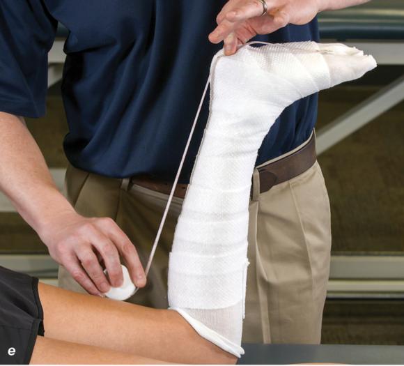 Figure 2.32 Posterior splinting procedure applied to immobilize the foot and ankle. Position the foot and ankle in the functional position, which is 0° of dorsiflexion. Measure 4 inches (10 cm) beyond the base of the popliteal fossa and 4 inches (10 cm) beyond the metatarsal heads to determine the amount of stockinette needed. Apply the stockinette. Beginning at the metatarsal heads, roll the cast padding circumferentially from distal to proximal ending at the base of the popliteal fossa. Measure from the base of the popliteal fossa to the metatarsal heads to determine the length of the splint. Starting at the metatarsal heads, position the posterior splint against the plantar surface of the foot and posterior aspect of the leg. Fold down any excess splint material at the knee. Fold the stockinette and cast padding over the ends of the fiberglass splint. Starting distally, secure the splint in place with an elastic wrap. () Completed posterior splint.