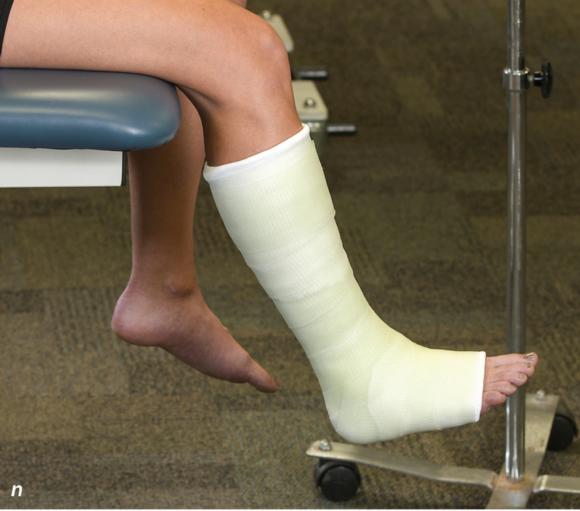 Figure 2.33 Non-weight-bearing short leg cast to immobilize the foot and ankle. Position the foot and ankle in the functional position, which is 0° of dorsiflexion. Measure 4 inches (10 cm) beyond the tibial tubercle and 4 inches (10 cm) beyond the metatarsal heads to determine the amount of stockinette needed. Apply the stockinette, and cut a slit in the stockinette across the front part of the ankle to eliminate any folds. Beginning at the metatarsal heads, roll the cast padding circumferentially from distal to proximal, overlapping by 50% to end at the tibial tubercle. Do not cover the heel at this time. Apply extra padding to protect the malleoli. Cast padding should now be applied to the heel. Starting at the metatarsal heads, begin applying the fiberglass from distal to proximal, overlapping the previous layer by 50%. Initially close in the foot and ankle with fiberglass, followed by the lower leg. Fold down the stockinette and secure the ends of the stockinette with the final layers of fiberglass. Using the palm and heel of your hand, mold the casting material as needed. () Completed non-weight-bearing short leg cast.